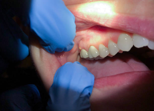 Best Dental Abscess Treatment in Shady Shores, TX